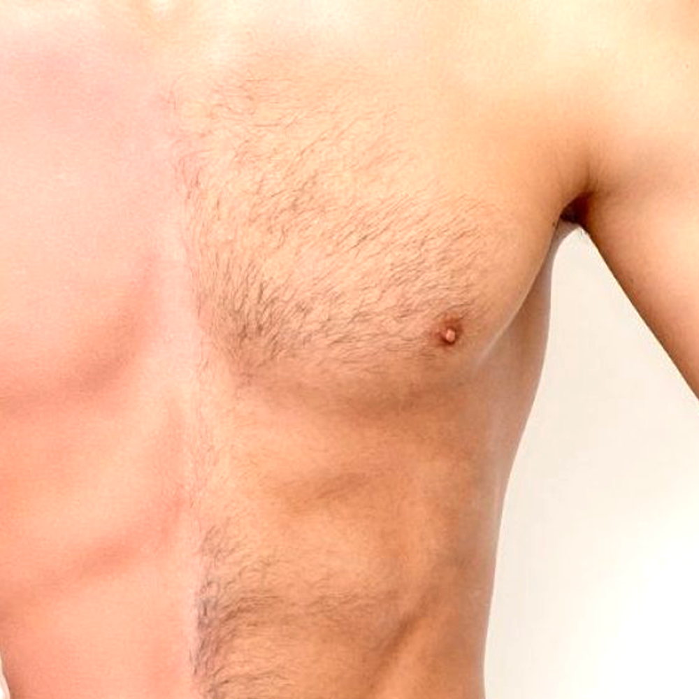 DEPILACIÓN LÁSER DIODO PECHO O ESPALDA HOMBRE