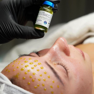 BIOREPEEL CON MICRONEEDLING